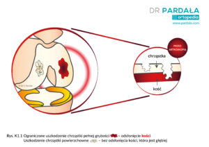 Chondromalacja i uszkodzenie chrząstki