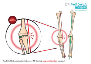 Osteotomia okołokolanowa HTO (korekcja nieprawidłowej osi kończyny)