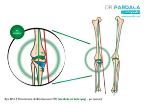 Osteotomia okołokolanowa HTO (korekcja nieprawidłowej osi kończyny)