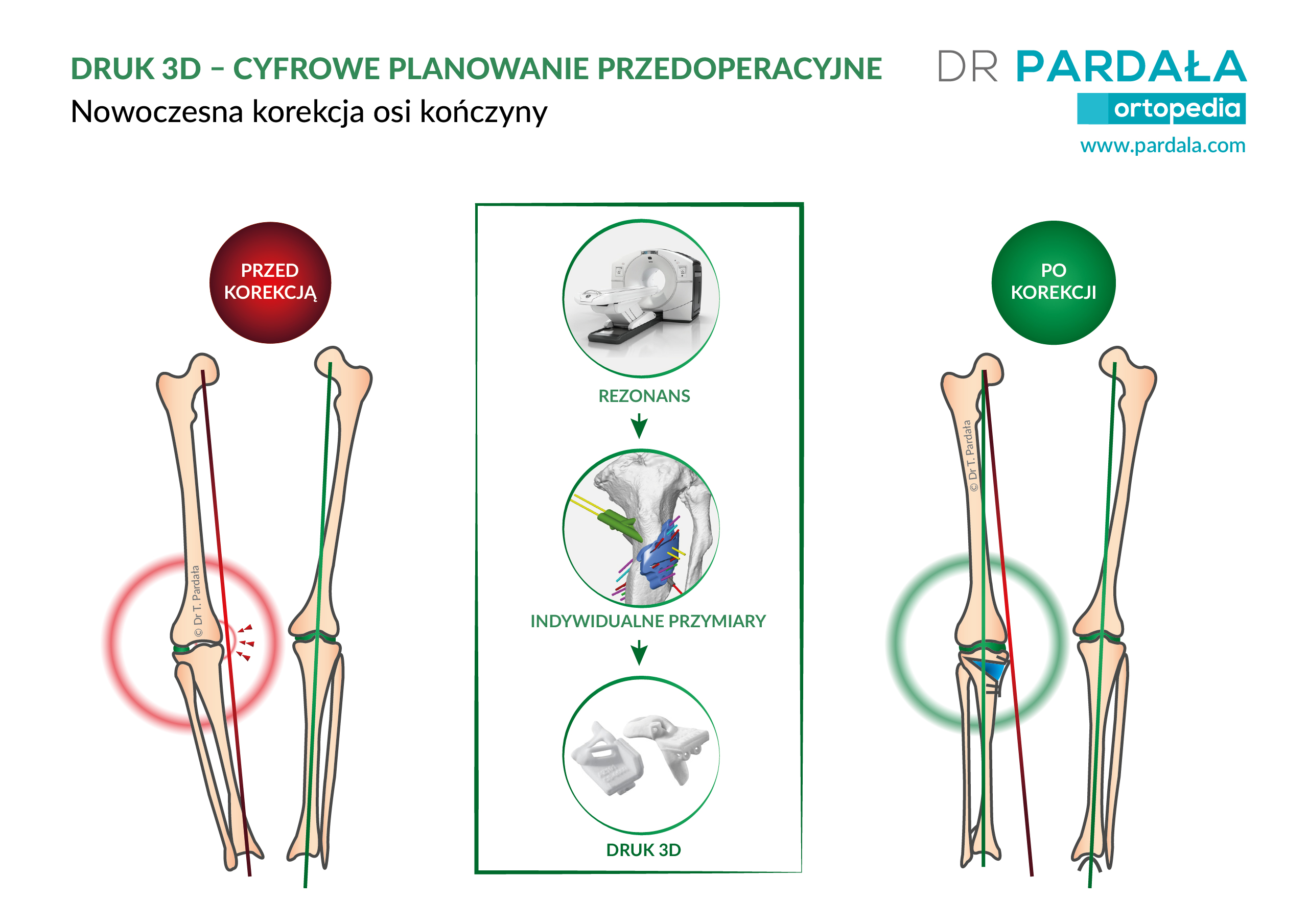 Osteotomia HTO z indywidualnymi cyfrowymi przymiarami 3D (PSI - Patient specific instruments)