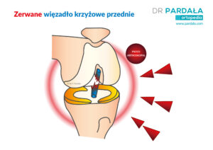 Zerwane więzadło krzyżowe przednie