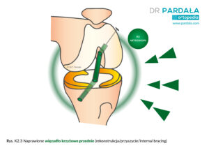 Więzadło krzyżowe przednie – rekonstrukcja / przyszycie / internal bracing