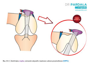 Zwichnięcie rzepki, zerwanie więzadła rzepkowo-udowego (MPFL)