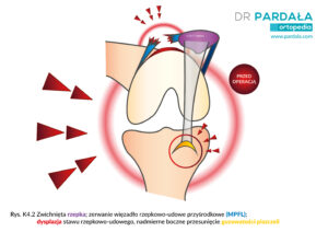 Zwichnięcie rzepki, dysplazja stawu rzepkowo-udowego; transfer guzowatości piszczeli; trochleoplastyka