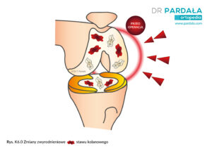 Zmiany zwyrodnieniowe kolana