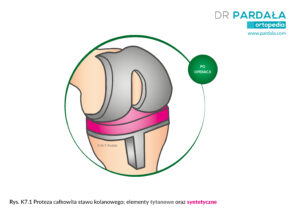 Proteza całkowita kolana