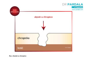 Ubytek w chrząstce