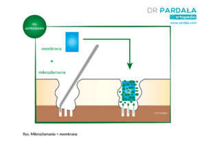 Mikrozłamania + membrana