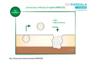 Przeszczep mielonej chrząstki (MINCED)